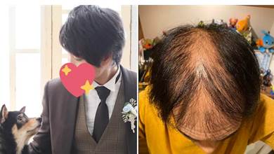 日本小哥打完疫苗瘋狂脫髮，求醫吃藥不管用，百天后可能光頭，他卻發推直言：不後悔~