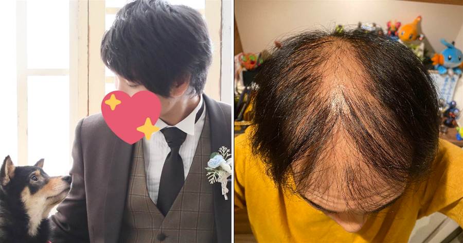 日本小哥打完疫苗瘋狂脫髮，求醫吃藥不管用，百天后可能光頭，他卻發推直言：不後悔~